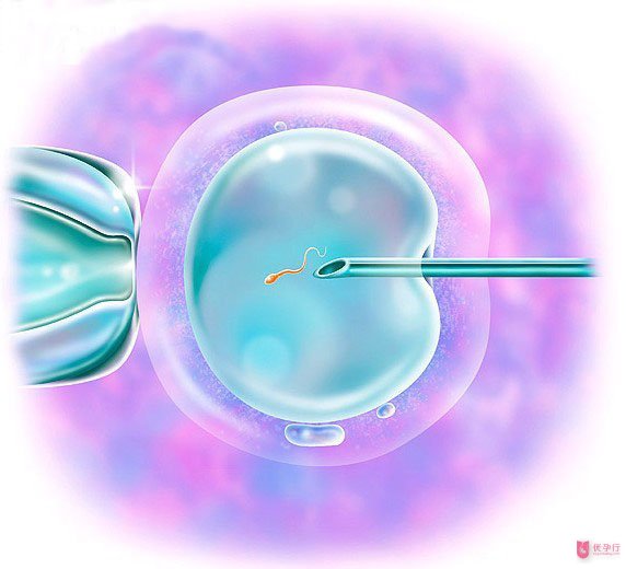 這些因素會影響試管嬰兒的胚胎質量
