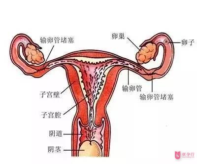 育齡女性都應(yīng)該知道的輸卵管堵塞知識!